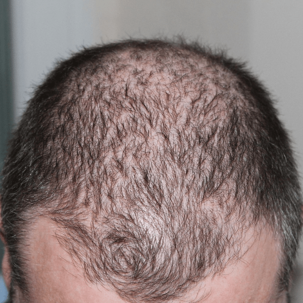 Man onderzoekt zijn haaruitval; natuurlijke haargroei met saw palmetto en pompoenzaad helpt haaruitval verminderen volgens onderzoek.