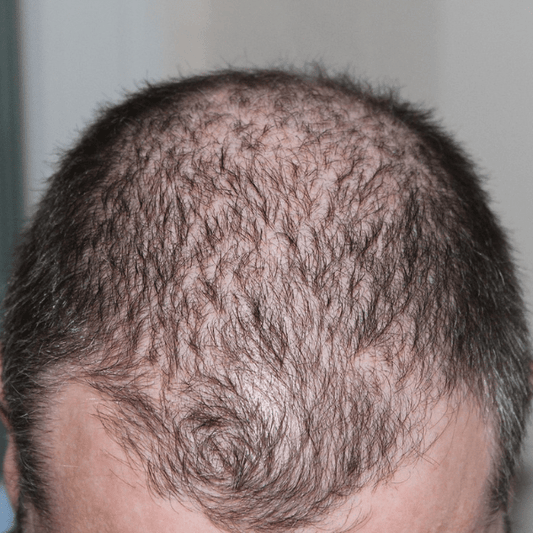 Man onderzoekt zijn haaruitval; natuurlijke haargroei met saw palmetto en pompoenzaad helpt haaruitval verminderen volgens onderzoek.