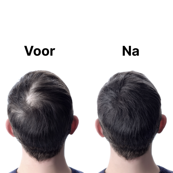 haarsupplement tegen haaruitval